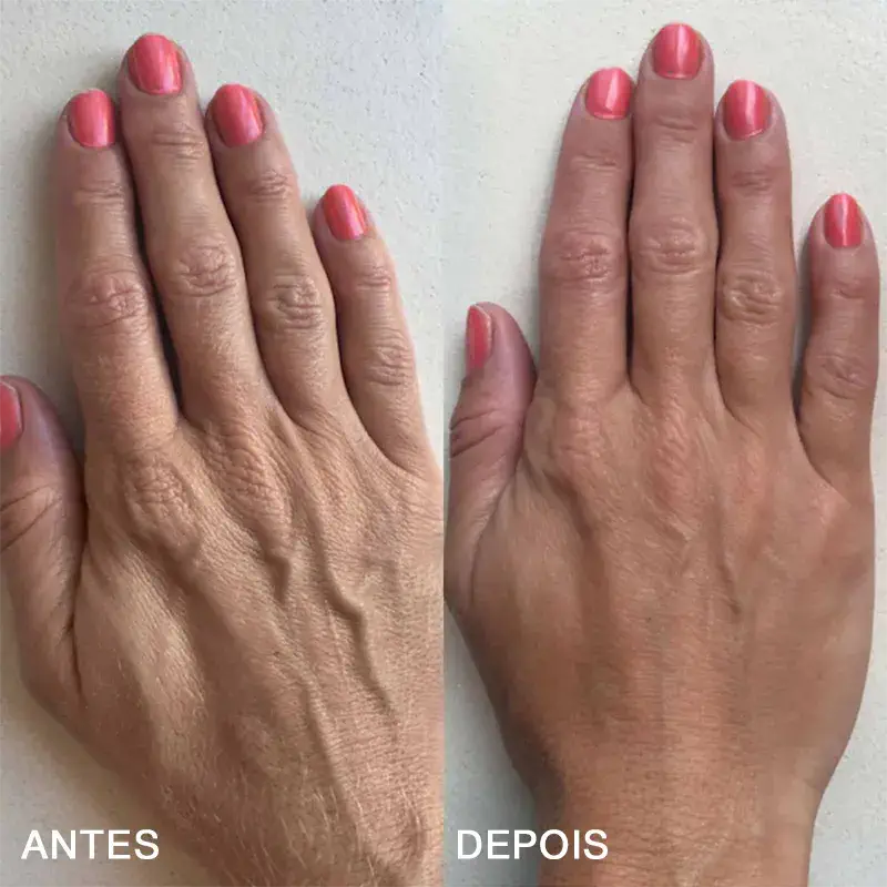 Adesivos para rugas nas mãos